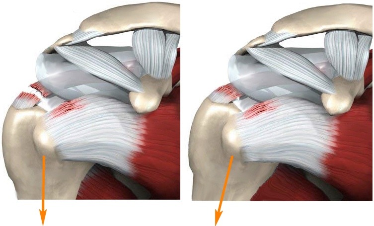 Arthroscopy of the shoulder joint3.jpg