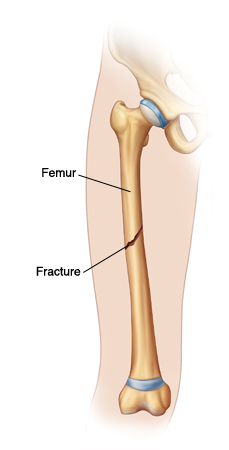 Fracture of femur