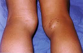 Knee joint disease. Baker's cyst