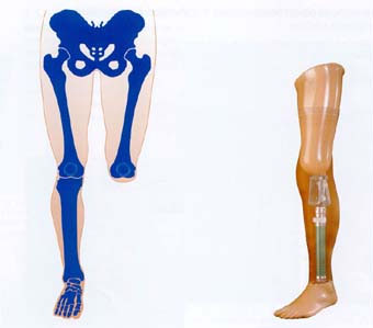 Prothese zur Kniegelenksextraktion.jpg