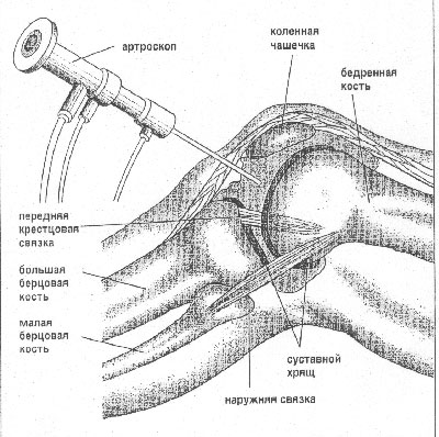 Arthroscopy of the knee joint2.jpg