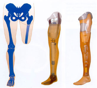 Hüftprothese.jpg