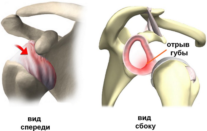 Arthroscopy of the shoulder joint2.jpg