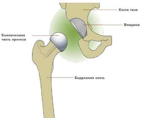 Еndoprosthesis of hip joint