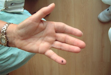  Косметический протез пальца левой кисти