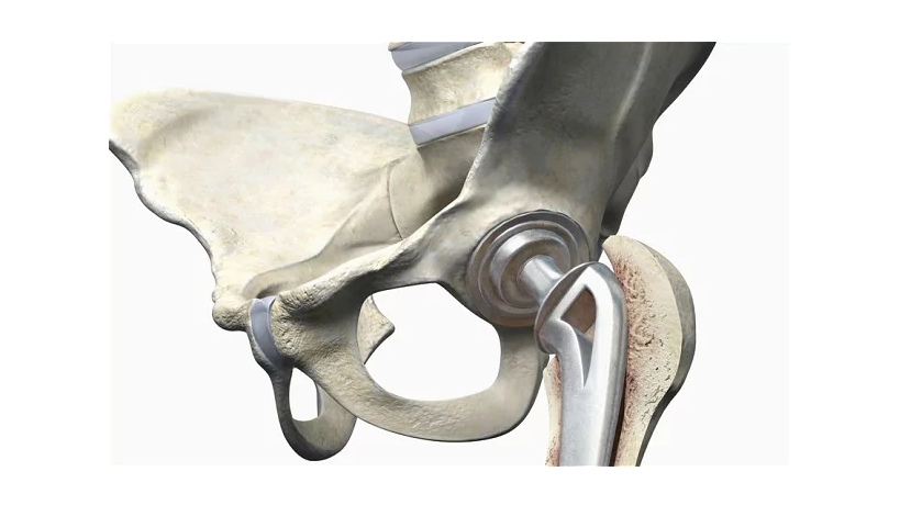Artificial hip joint