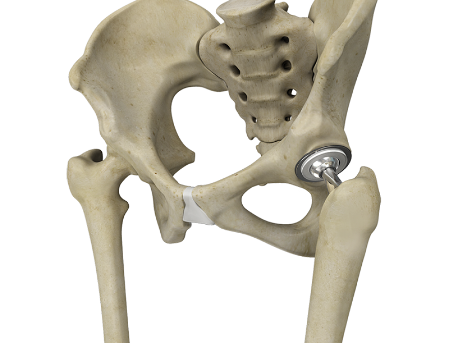 Искусственный сустав бедра