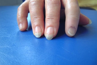 Косметический протез пальца правой кисти
