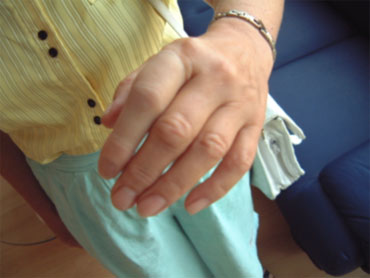  Косметический протез пальца левой кисти