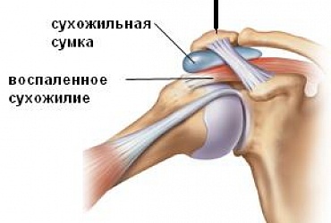 Аrthroscopy of shoulder joint