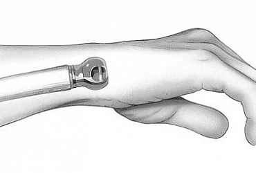 Endoprothetik der Gelenke der Hand