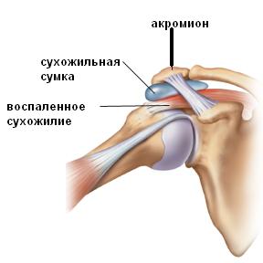 Аrthroscopy of shoulder joint