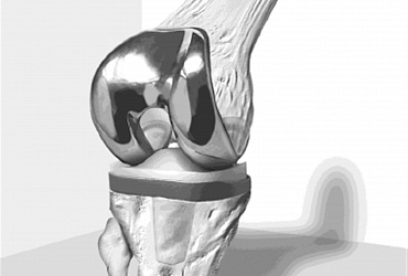 Еndoprosthesis of knee joint