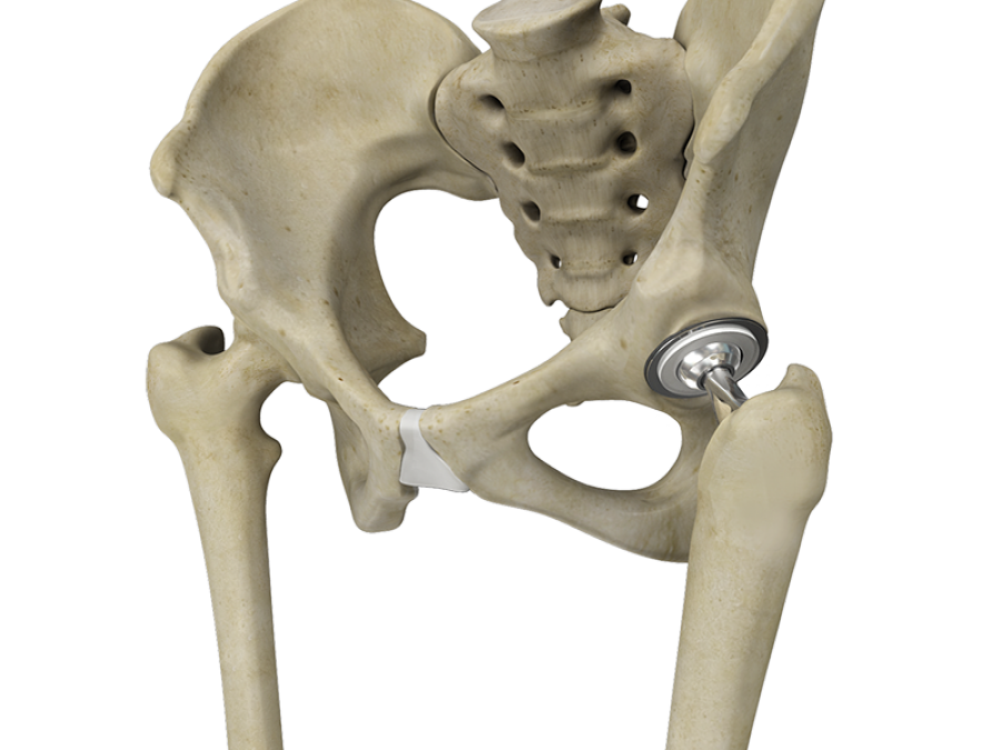 Artificial hip joint