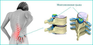 Микродискэктомия Микродискэктомия