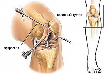 Аrthroscopy of knee joint