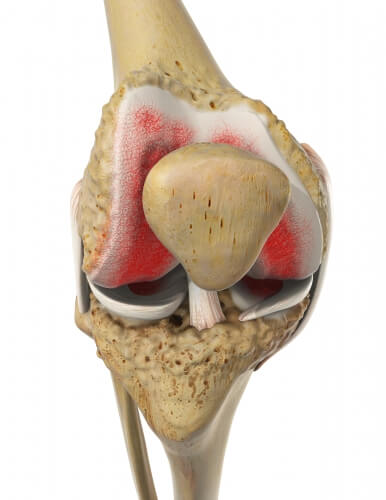 Еndoprosthesis of knee joint