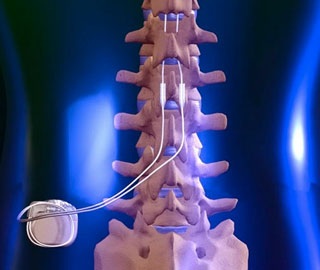 Neurostimulation des Rückenmarks (SCS)