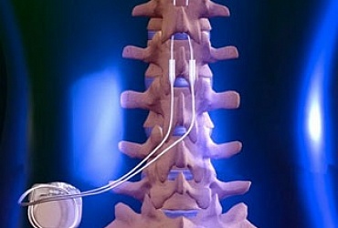Neurostimulation Therapy Treatment (Spinal Cord Stimulation)