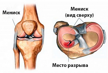 Injury of knee joint meniscus 