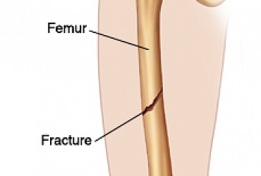 Fracture of femur