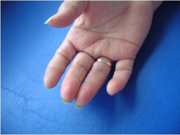 Косметический протез пальца правой кисти